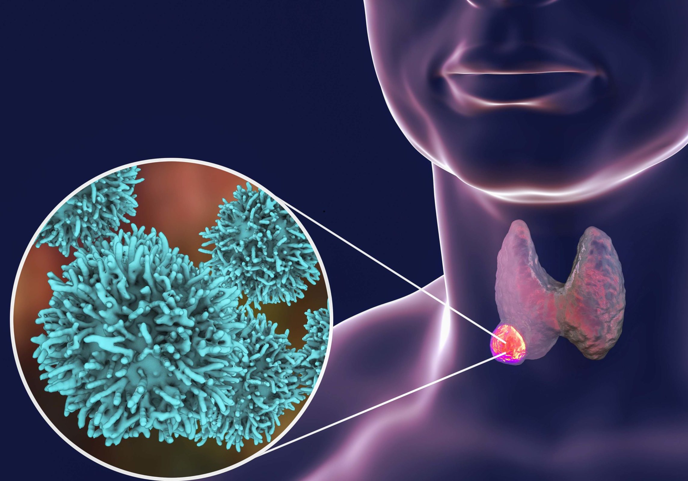 Thyroid cancer. 3D illustration showing thyroid gland with tumor inside human body and closeup view of thyroid cancer cells